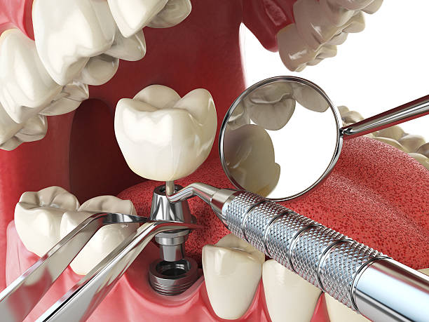 Best Emergency Treatment for Dental Infections or Abscesses in Bluffdale, UT